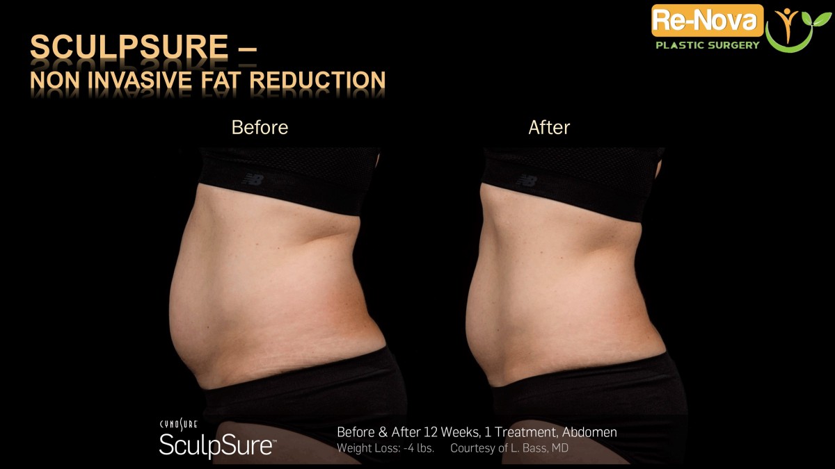 Sculpsure-Non invasive fat reduction-coolsculpting-laser3-ReNova-Julio-Clavijo-Pittsburgh–Wexford–Monroeville-Greensburg-Ohio-WestVirginia