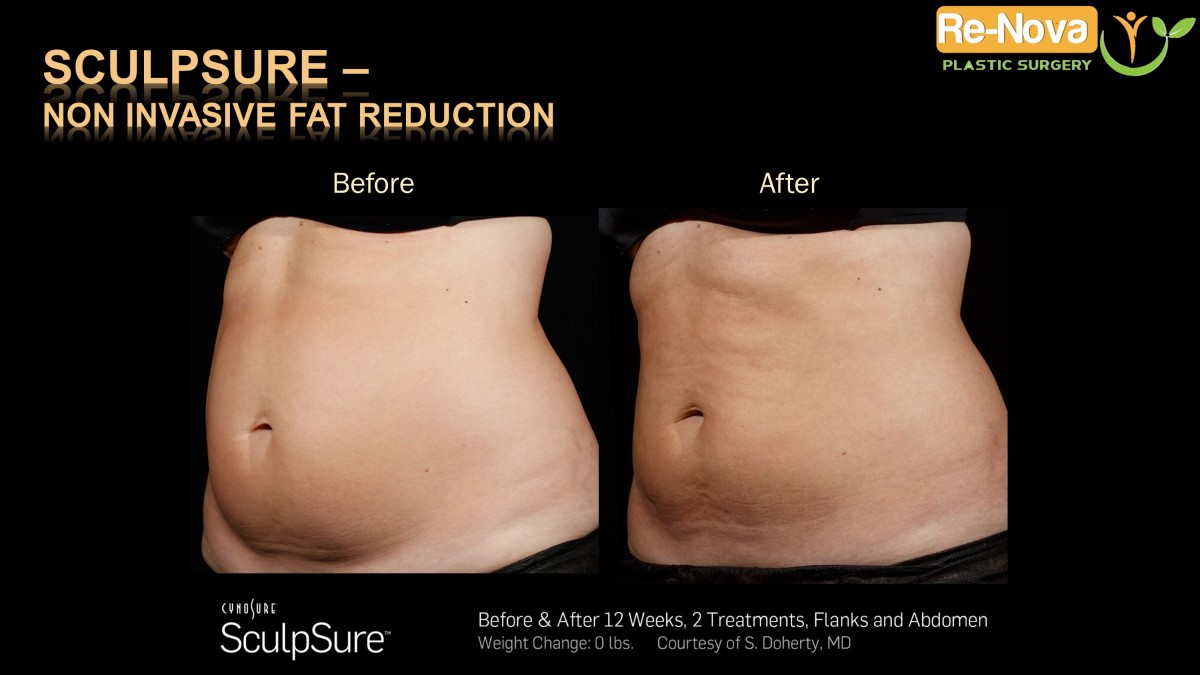 Sculpsure-Non invasive fat reduction-coolsculpting-laser4-ReNova-Julio-Clavijo-Pittsburgh–Wexford–Monroeville-Greensburg-Ohio-WestVirginia