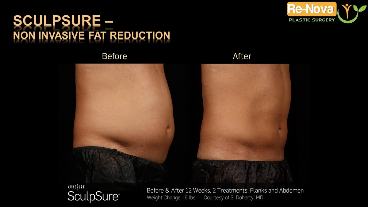 Sculpsure-Non invasive fat reduction-coolsculpting-laser5-ReNova-Julio-Clavijo-Pittsburgh–Wexford–Monroeville-Greensburg-Ohio-WestVirginia