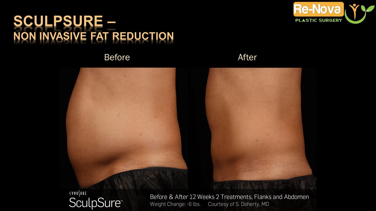 Sculpsure-Non invasive fat reduction-coolsculpting-laser6-ReNova-Julio-Clavijo-Pittsburgh–Wexford–Monroeville-Greensburg-Ohio-WestVirginia
